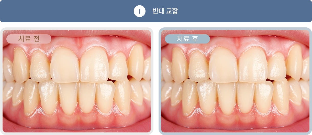 치아교정 치료사례