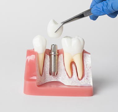 임플란트