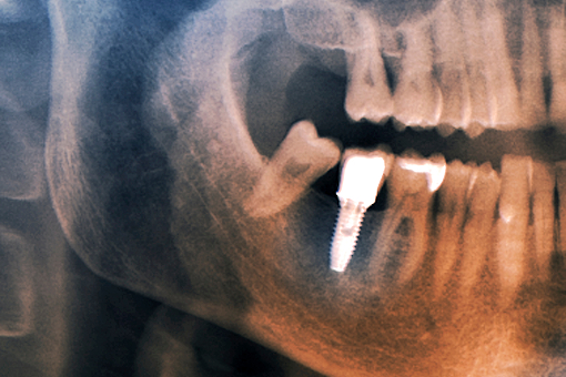 레더스스마일치과 임플란트 장점2