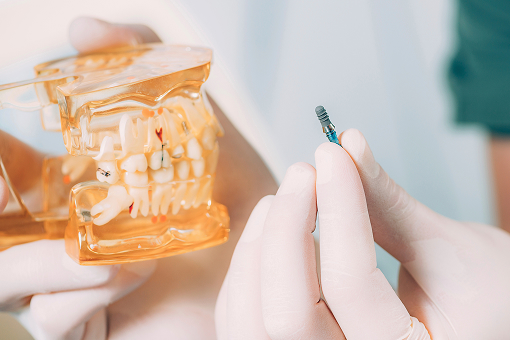 레더스스마일치과 임플란트 장점3