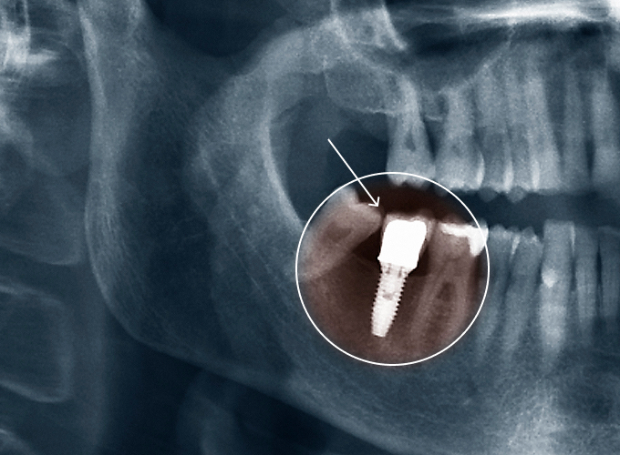 임플란트 치료사례