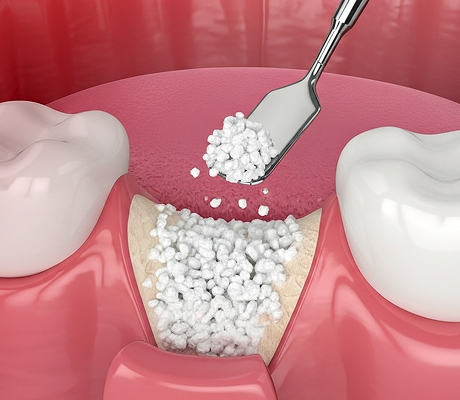 뼈 보강 치료(뼈 이식술)