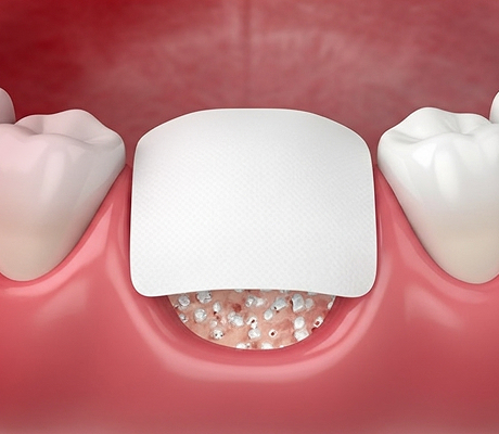 골유도 재생 치료(GBR)