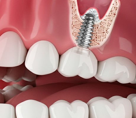 상악동 보강 치료(상악동 거상술)